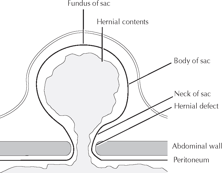 Abdominal Hernia Upper Abdomen
