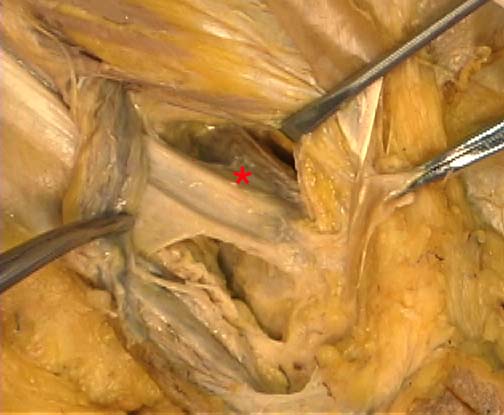 inguinal ligament cadaver