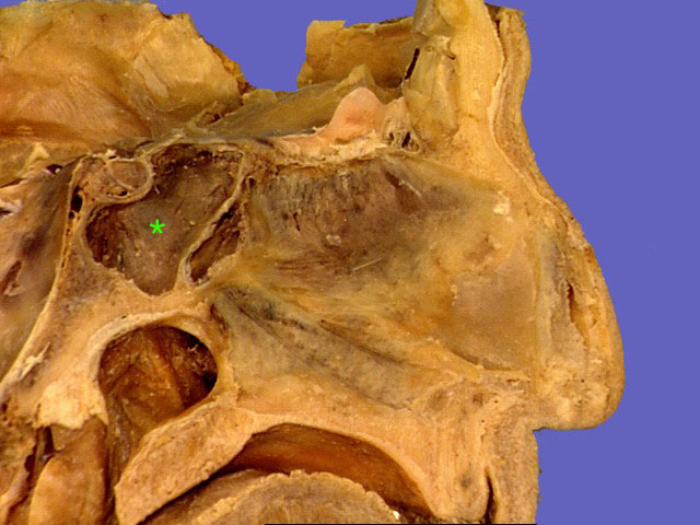 Featured image of post Semi Lunar Hiatus Medical definition of hiatus semilunaris